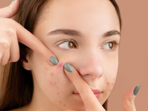 natural ingredients to fight acne