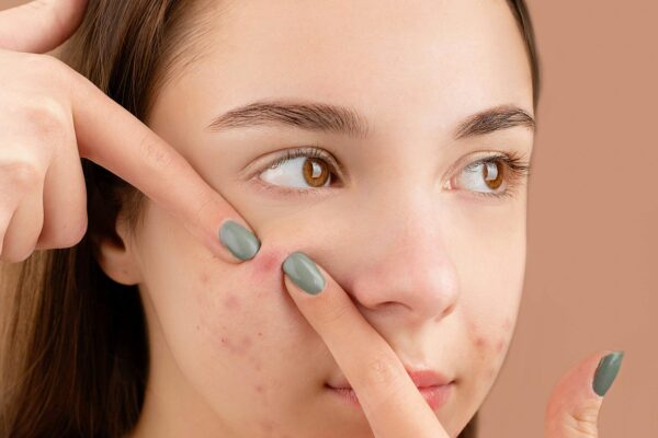 natural ingredients to fight acne